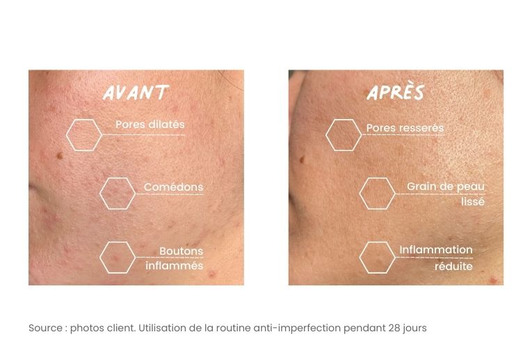 BLOGIMG_IMPERFECTION_AVANT_APRES avant après routine anti imperfection