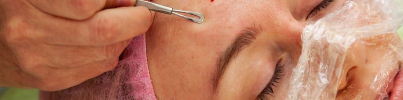 BLOGIMG_COMEDON_EN_INSTITUT extraction des comédons en institut de beauté