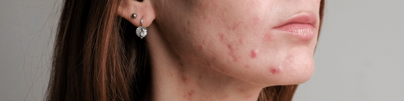 BLOGIMG_ACNE_ADO_IMPERFECTIONS dospívající akné